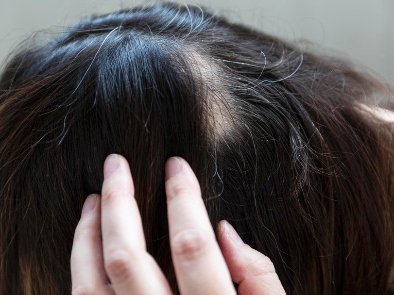 Alopecia Areata Treatment with Homeopathy