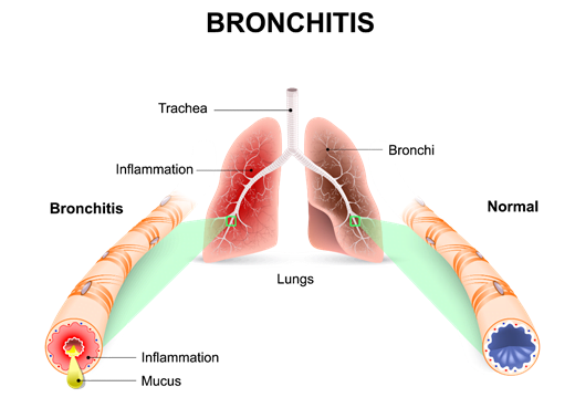 Bronchitis 