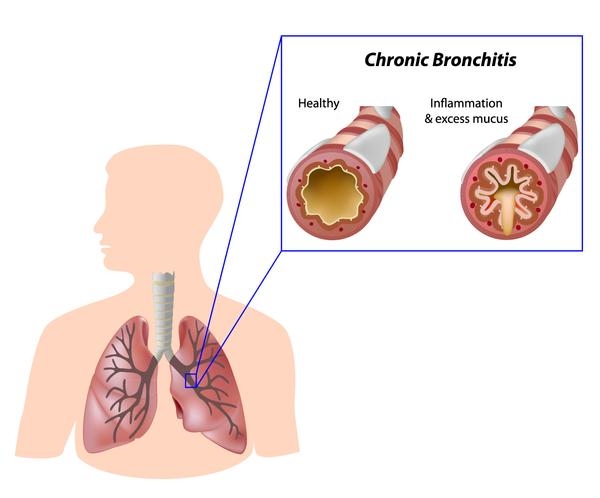 Bronchitis Treatment