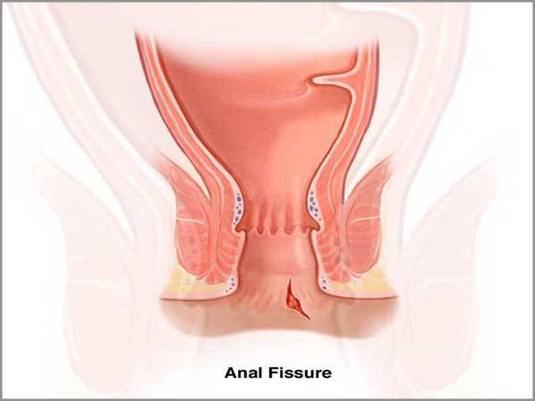 Anal Fissure