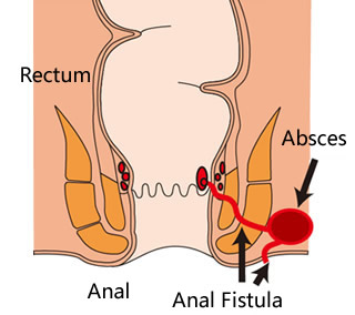 Fistula