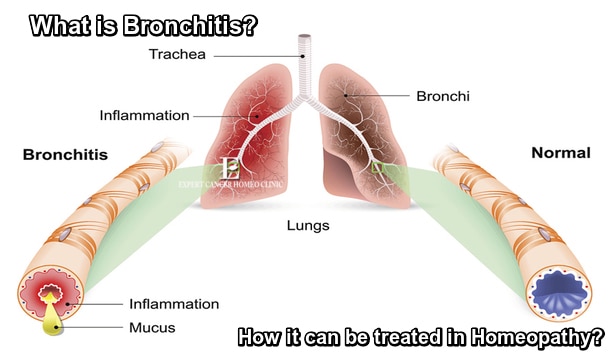 Bronchitis treatment