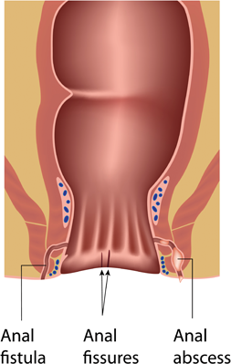 Fistula Treatment 