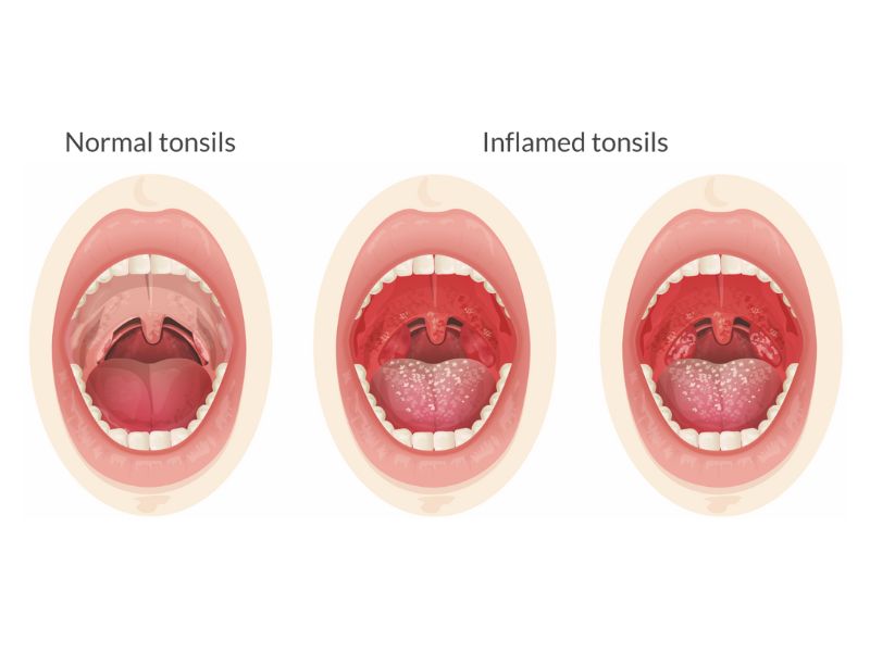 Tonsilitis