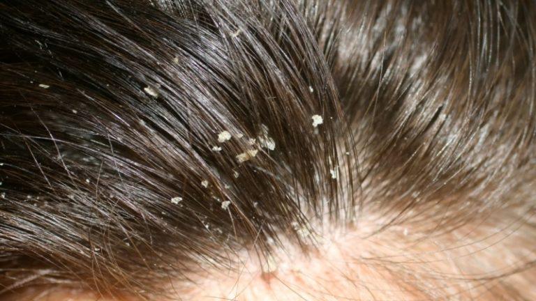 Dandruff Treatment 